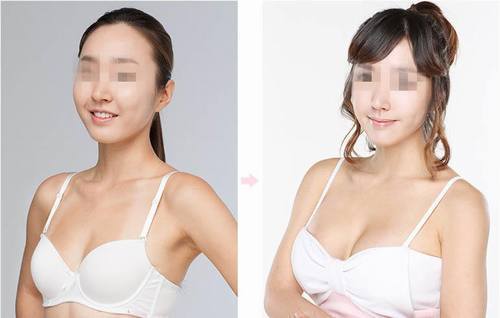 假体隆胸恢复时间需要多久?