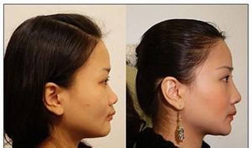 玻尿酸垫鼻子果好吗?