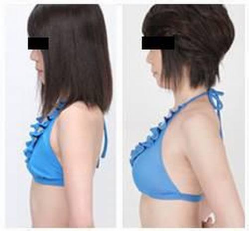 假体丰胸的费用高不高?