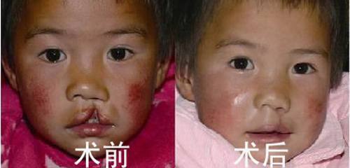 兔唇修复手术何时做较好