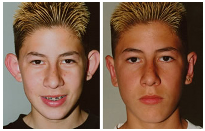 招风耳可以矫正吗